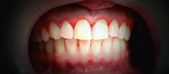 Jakie są objawy gromadzenia się kamienia nazębnego, które powinny nas zaniepokoić?