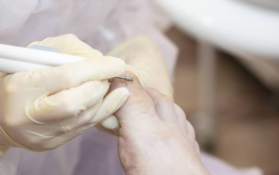 Dlaczego warto usunąć odcisk z korzeniem w gabinecie podologicznym?