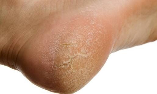 Jakie są różnice między różnymi typami brodawek na stopach?