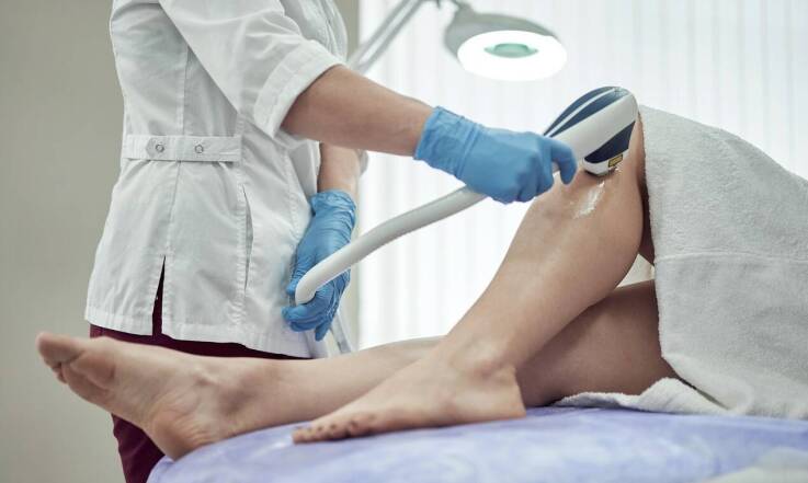 Proces laserowego usuwania żylaków: czego się spodziewać?