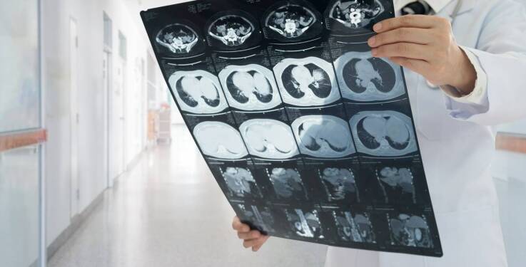 Prześwietlenie płuc jako narzędzie w ocenie skuteczności leczenia