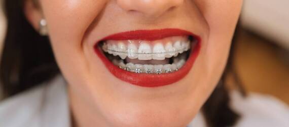 Jak pielęgnować zęby podczas noszenia ortodontycznego aparatu?
