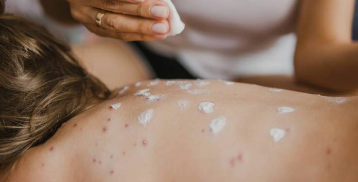 Alergologiczne metody leczenia skóry atopowego zapalenia