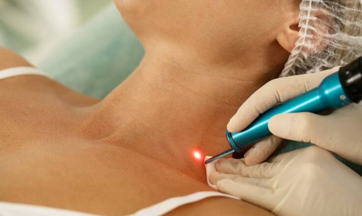 Jak depilacja laserowa wpływa na delikatne obszary ciała, takie jak podbródek i wąsik?