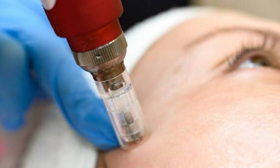 Skuteczność igłowej mezoterapii w walce z oznakami starzenia.