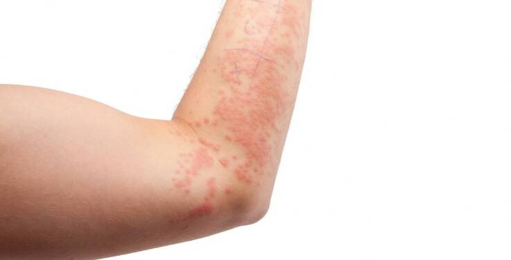 Zmiany skórne a ogólne zdrowie - co mogą sygnalizować problemy ze skórą?