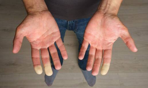Jakie są najnowsze trendy w terapii nadpotliwości dłoni w podologii?