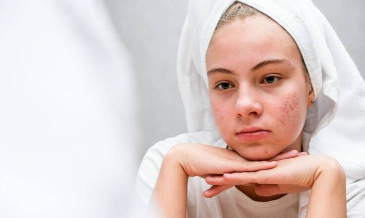 Jakie wyróżnia się rodzaje trądziku?