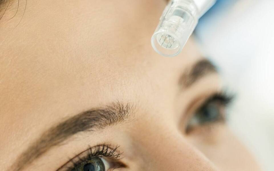 Rola Dermapen w walce z wiotkością skóry i zmarszczkami