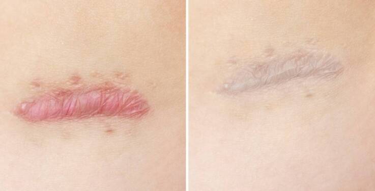 Proces gojenia po usuwaniu blizn - czego się spodziewać?