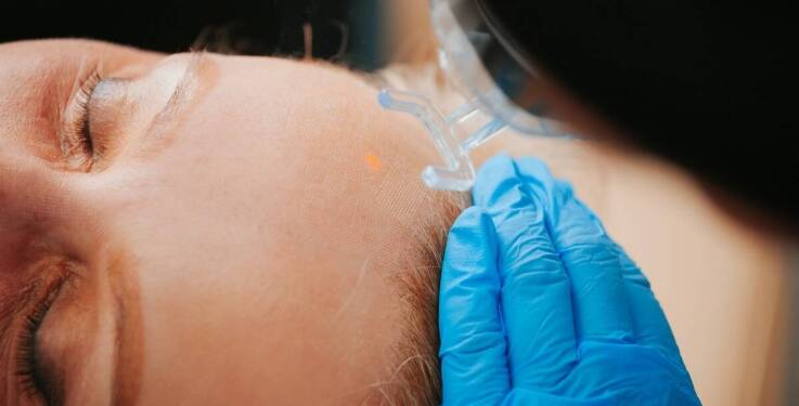 Dermapen w walce z bliznami – efektywność i zalecenia po zabiegu