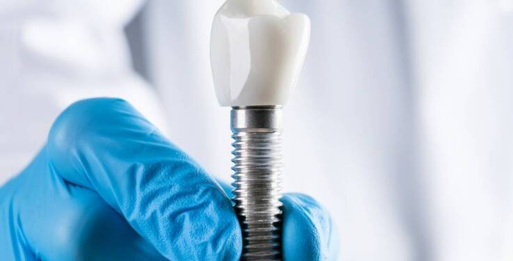 Jakie korzyści płyną z zastosowania zębowych implantów w estetycznej stomatologii?