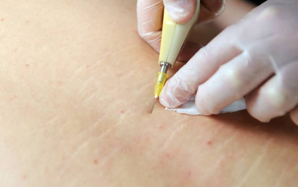 Wpływ mikroigłowej mezoterapii na redukcję blizn i przebarwień