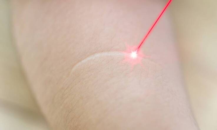Kiedy skóra nie jest gotowa na depilację laserową i kiedy przełożyć wizytę