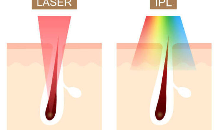 Fototyp skóry i kolor włosów — dlaczego depilacja laserowa wymaga innej liczby sesji