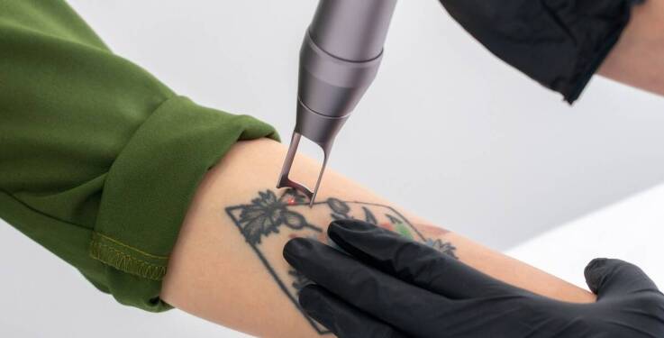 Laserowe usuwanie tatuażu: jak skóra reaguje i kiedy planować kolejną sesję