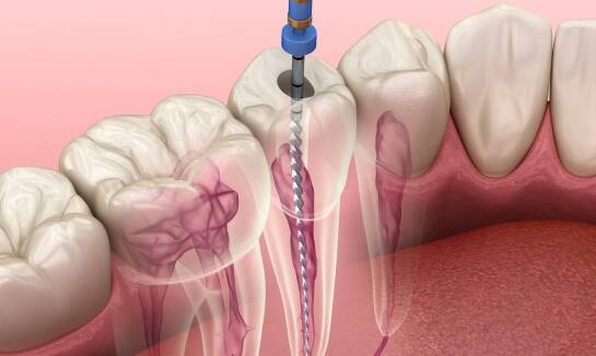 Leczenie bezzębia na czterech implantach — od badań obrazowych do stałej odbudowy
