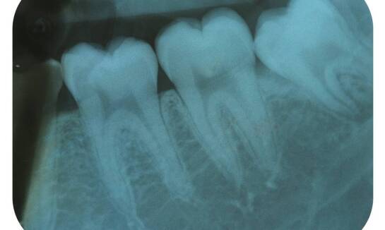 Objawy, które odróżniają zwykłą nadwrażliwość od stanu wymagającego diagnostyki endodontycznej